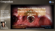 Next Generation Implant System: Preserving Patient Vital Tissues and Making Predictable Immediacy a Reality Webinar Thumbnail