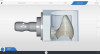 Fig 2. Restoration design and milling preview in CEREC software.