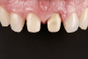 Fig 15. Case example 1. Fig 15: Intraoral view of the maxillary central incisor preparations. Fig 16 and Fig 17: Postoperative intraoral and extraoral views.