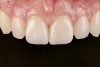 Fig 16. Case example 1. Fig 15: Intraoral view of the maxillary central incisor preparations. Fig 16 and Fig 17: Postoperative intraoral and extraoral views.