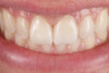 Fig 17. Case example 1. Fig 15: Intraoral view of the maxillary central incisor preparations. Fig 16 and Fig 17: Postoperative intraoral and extraoral views.