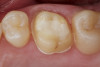 Fig 18. Case example 2. Fig 18: Intraoral view of left maxillary first molar preparation (No. 14). Fig 19: Palatal view of a conservative supragingival margin.