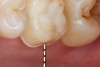 Fig 19. Case example 2. Fig 18: Intraoral view of left maxillary first molar preparation (No. 14). Fig 19: Palatal view of a conservative supragingival margin.