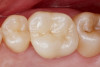 Fig 20. Case example 2. Fig 20: Postoperative intraoral occlusal view. Fig 21: Postoperative intraoral buccal view.