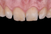 Fig 1. Preoperative intraoral view; maxillary incisors and canines are to be restored with ceramic laminate veneers.