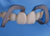 Fig 4. Insertion with light-cure composite resin luting agent under rubber dam isolation.