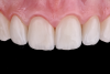 Fig 5. Post-cementation intraoral view.