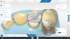 Fig 6. Inlay restoration designed on maxillary first premolar after intraoral scan.