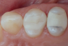 Fig 11. Post-cementation intraoral view.