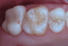 Fig 12. Preoperative intraoral view; second molar is to be restored with a resin-bonded zirconia restoration.