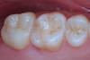 Fig 17. Post-cementation intraoral view.