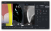 Fig 6. Calibrated tri-view imaging showing the intraoral scan with the 3D design overlapped (left), the cross-section view containing the intraoral scan, design, and DICOM file (center), and the DICOM medical viewer with measurements of the necessary biological width for the crown lengthening design (right).