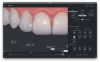 Fig 10. Incisal embrasure gradation.