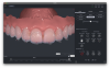 Fig 11. Measurements of amount of increase needed in incisal edges.