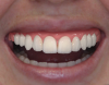 Fig 12. Dominant smile: Incisal edges of the lateral incisors are slightly elevated relative to the incisal edges of the central incisors.