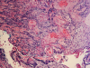 Fig 2. Squamous cell carcinoma of the gingiva (magnification 100x).
