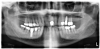 Fig 4. Panoramic radiograph. Both implants (Nos. 13 and 30) demonstrated similar horizontal bone loss confined to the coronal one-third.