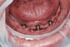 Fig 6. (Case study 2) Intraoral view of implants following placement of locator-type attachments (3-month follow-up). Clinically healthy gingiva was present with no signs of looming tumor growth.