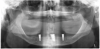 Fig 7. Panoramic radiograph of implants following placement of locator-type attachments (3-month follow-up). Implants were well integrated with normal-appearing peri-implant bone.