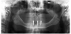 Fig 8. Panoramic radiograph of implants at 6-month follow-up. Significant bone loss and thread exposure were noted around not only the affected implant No. 24 but all three implants.