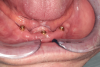 Fig 9. Intraoral view of the lesion around implant No. 24. The large, non-homogenous leukoplakia extended from the implant site to the floor of the mouth. The lesion had sharply demarcated borders and a granular surface.