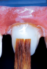 Fig 7. After a dual-cured composite resin cement is injected into the post channel, the reinforcement fiber is placed to the base of the post channel, and the ends of the fiber are folded back into the channel and arranged into the desired shape of the core and light-cured for 60 seconds (Fig 6). A dual-cured or light-cured composite is injected over the coronal fibers, and the composite material is adapted, sculpted, and smoothed with a No. 2 sable brush into the desired form and dimension of an ideal preparation (Fig 7).