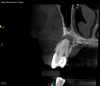 Fig 2. Case demonstrating successful healing of tooth No. 5 following a flare-up incident. Fig 2: Patient presented with asymptomatic apical periodontitis of tooth No. 5. Fig 3: Following initiation of NSRCT, the patient developed a flare-up with swelling and pain. Amoxicillin was prescribed and the calcium hydroxide medicament was replaced. Fig 4: The patient returned 3 months later with radiographic healing of the apical periodontium. Fig 5: Obturation was completed.