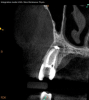 Fig 4. Case demonstrating successful healing of tooth No. 5 following a flare-up incident. Fig 2: Patient presented with asymptomatic apical periodontitis of tooth No. 5. Fig 3: Following initiation of NSRCT, the patient developed a flare-up with swelling and pain. Amoxicillin was prescribed and the calcium hydroxide medicament was replaced. Fig 4: The patient returned 3 months later with radiographic healing of the apical periodontium. Fig 5: Obturation was completed.