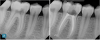 Fig 2. Using the endo-restorative workflow described in this article, the complex anatomy shown in these radiographs was able to be irrigated by multisonic
irrigation. Fig 1, left panel: Preoperative radiograph of tooth No. 14 with acute periapical abscess and dental caries in a 20-year-old male patient with good dental
and overall health. A filling had broken, and the patient had postponed treatment. Fig 1, right panel: Postoperative radiograph (after the single-visit endo-restorative
workflow). Fig 2, left panel: Preoperative radiograph of tooth No. 30 with internal inflammatory root resorption, a rare condition, resulting in acute periapical abscess in
another 20-year-old male patient with good dental and overall health. Fig 2, right panel: Postoperative radiograph (after the single-visit endo-restorative workflow).