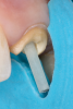 Fig 1. Example of the ferrule effect. The completed crown preparation should have a ferrule design, as shown, that encapsulates the endodontically restored tooth complex.