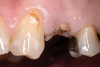 Fig 2. Restorative failure of an existing amalgam restoration on the maxillary left first premolar from recurrent caries.