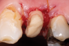 Fig 3. After endodontic treatment, crown lengthening was performed to develop an ideal ferrule effect.