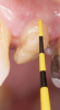 Fig 4. An adequate collar effect of 2 mm of sound tooth structure would provide an anti-rotational feature for the stability of the crown.