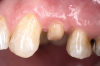 Fig 5. Buccal view of optimal ferrule effect with a healthy biological framework.