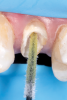 Fig 14. Application of universal adhesive onto the walls and base of the channel.