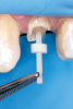 Fig 16. Fiber post inserted into the post space to the base of the prepared channel.