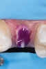 Fig 18. The remaining sound tooth structure (ferrule) was etched for 15 seconds with a 37.5% phosphoric acid semigel, rinsed for 5 seconds, and air-dried.