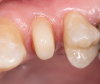 Fig 23. The completed post and core with an ideal ferrule dimension.