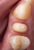 Fig 24. Occlusal view of the all-ceramic crown preparation with a full chamfer providing a 2 mm ferrule of sound tooth structure.