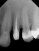 Fig 25. Radiograph revealed an optimal integration at the adhesive interfaces.