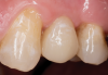 Fig 26. The adhesive assembly on the maxillary left first premolar provided a mono­block dentin/post/core/crown system that allows for an optimal distribution of forces along the root.