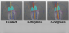 Fig 2. Degrees of angular deviation achieved with the dynamic navigation and free-hand techniques, respectively. Left panel: Optimal angular deviation that should be achieved with guided surgery. Middle panel: Angular deviation achieved with dynamic navigation. Right panel: Angular deviation achieved with free-hand surgery.