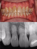 Fig 14. Preoperative view of a partially dentate case. Patient with root blunting and grade 3 mobility.