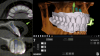 Fig 15. The case was planned using navigation planning software in this same patient.