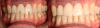 Fig 17. Views of the milled PMMA screw-retained provisional restoration. Note the screw access holes in the incisor edges (left panel). (Images courtesy of Dr. Kim Knoll.)