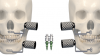 Fig 20. Minimally invasive intraoral screws in ideal position. Left: horizontal orientation. Right: vertical orientation.