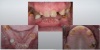 Fig 26. Mutilated dentition in an edentulous patient.