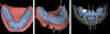 Fig 28. Views of virtual digital denture used to plan implant position.