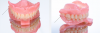 Fig 29. PMMA-milled transitional provisionals. Arrows indicate occlusal locks.