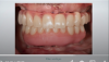 Fig 30. Retracted view of the patient’s dentition at 1 week postoperatively.